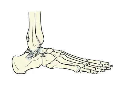 捻挫による靭帯損傷
