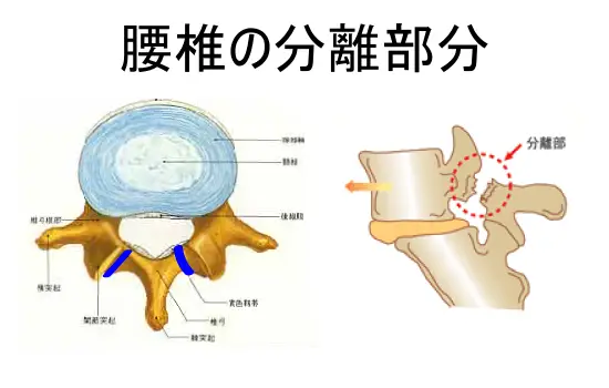 腰椎の分離する部位