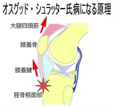 オスグットの原因